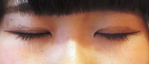 術後1ヶ月　閉眼